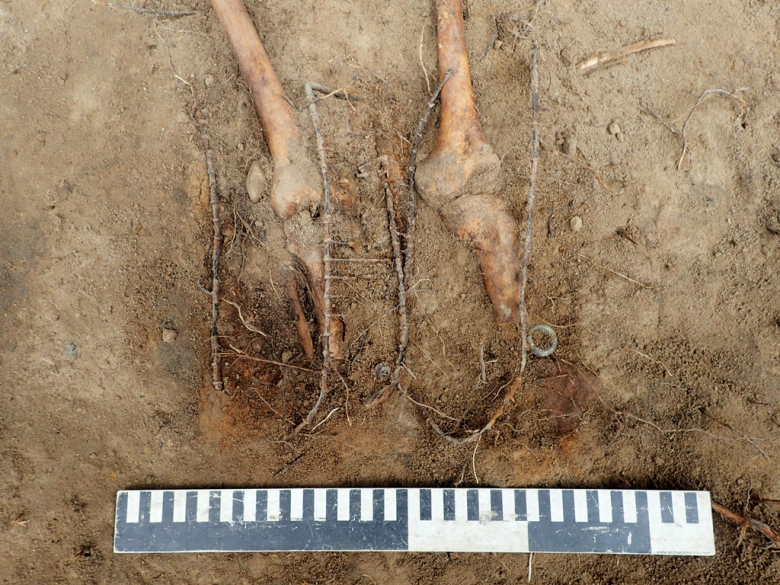 W grobach widnieją liczne ślady zabiegów i operacji medycznych m. in. opatrunki, dreny, szyny Kramera oraz amputacji kończyn